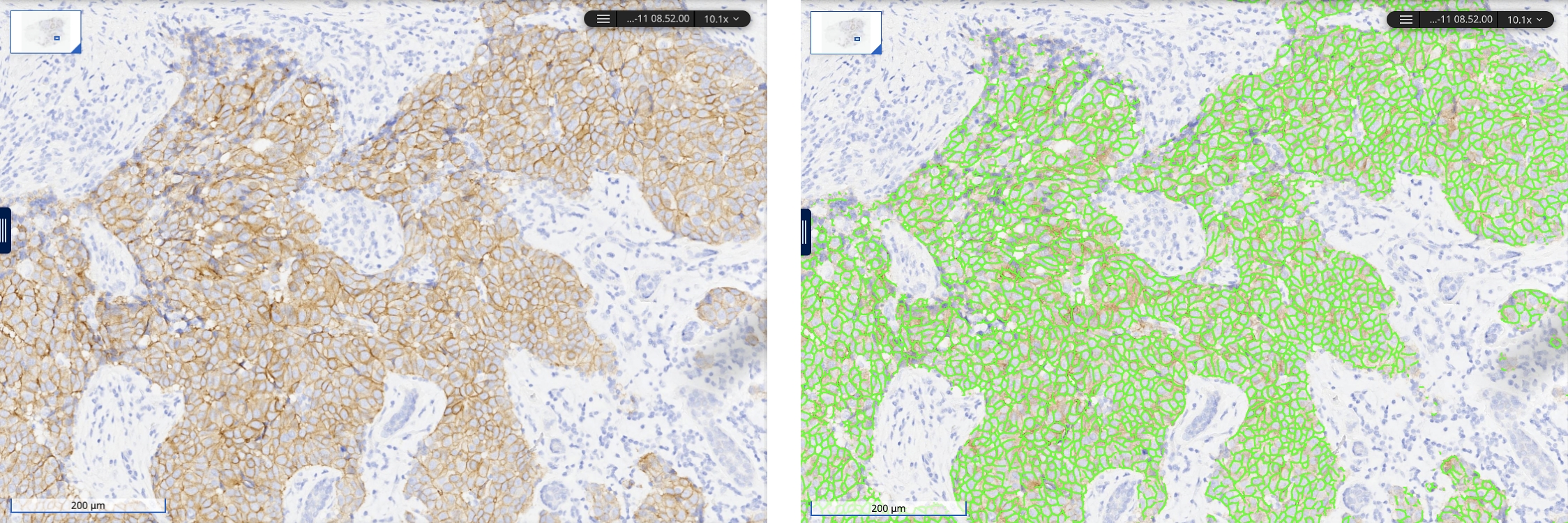 Side-by-side comparison of a tissue sample with and without AI-assisted analysis.